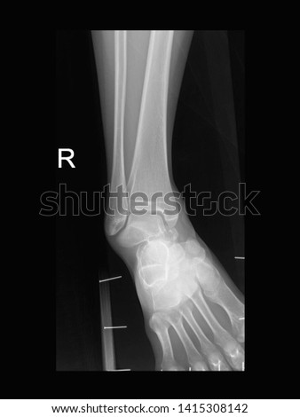 film foot X-ray radiograph showing ankle bone broken (talus bone of tarsus fracture) from sport injury.  medical imaging concept  Royalty-Free Stock Photo #1415308142