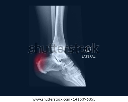 Film X-ray lateral ankle radiograph showing calcium deposit on Achilles tendon (Achilles tendonitis) and bone spur (Haglund deformity). The calcified tendon cause heel pain and shoe wear problem. Royalty-Free Stock Photo #1415396855
