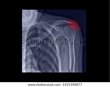 Film X-ray shoulder radiograph showing calcium deposit on rotator cuff tendon (calcific tendinitis or tendinosis). The calcified tendon cause shoulder pain and stiffness. medical concept Royalty-Free Stock Photo #1415398877