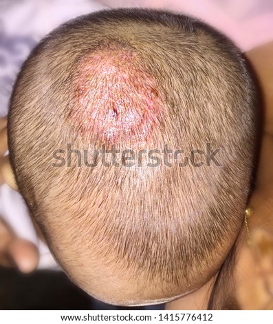 Treated Tinea Capitis or Fungal Infection on Scalp of Southeast Asian, Burmese two years old  Child in Clinic Royalty-Free Stock Photo #1415776412