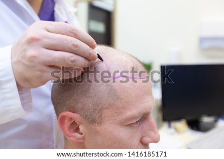 Baldness treatment. Patient suffering from hair loss in consultation with a doctor. Preparation for hair transplant surgery. The line marking the growth of hair. The patient controls the marking in Royalty-Free Stock Photo #1416185171