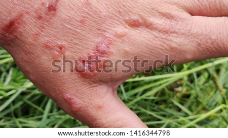 First degree burn of skin. Burns of hand, wounds. Influence poison of Heracleum (Giant Hogweed, Cow parsnip) on skin. One week after defeat poison Royalty-Free Stock Photo #1416344798