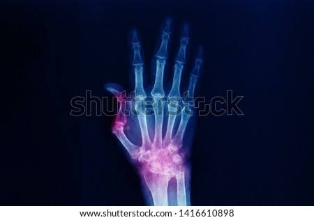 A hand and wrist x-ray showing severe arthritis of the wrist or carpus and Boutonniere deformity of the thumb. The patient has advanced rheumatoid arthritis. Dark background. Royalty-Free Stock Photo #1416610898