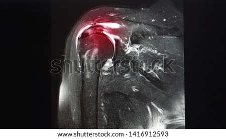 A coronal view magnetic resonance image or MRI of shoulder showing partial tear of supraspinatus tendon. The tendon is a part of rotator cuff tendon. Patient may needed arthroscopic surgery. Royalty-Free Stock Photo #1416912593