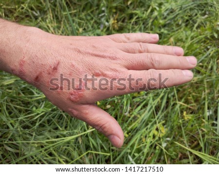 First degree burn of skin. Burns of hand, wounds. Influence poison of Heracleum (Giant Hogweed, Cow parsnip) on skin. One week after defeat poison Royalty-Free Stock Photo #1417217510