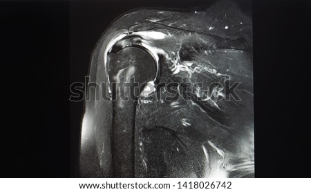 A coronal view magnetic resonance image or MRI of shoulder showing partial tear of supraspinatus tendon. The tendon is a part of rotator cuff. Patient may needed arthroscopic surgery. Royalty-Free Stock Photo #1418026742