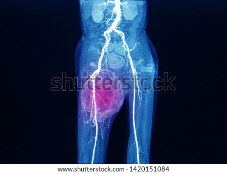 an computer tomography or CT image with angiogram showing aorta and artery with feeding vessel to a large cancer at right thigh. The patient need surgery. red highlight focus on the tumor. Royalty-Free Stock Photo #1420151084
