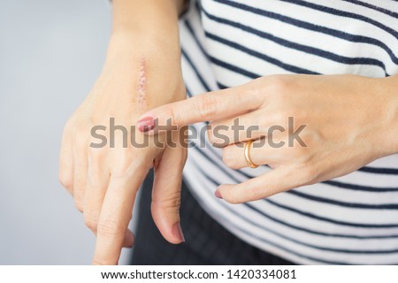 Close up: First degree heat burn scar on a woman's hand. The wound damage on epidermis outermost layer of skin. Healing, Removal, Treatment, Accident in the kitchen, Scar, Scald, Wound Healing, Repair Royalty-Free Stock Photo #1420334081