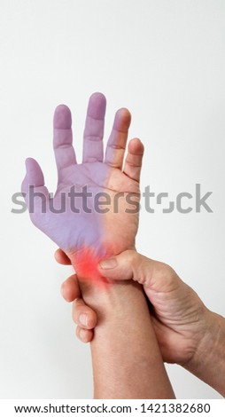 Hand anatomy. The patient suffer from  symptom wrist pain (red highlight), numbness and tingling(blue highlight) from carpal tunnel syndrome disease(CTS, median nerve entrapment). medical problem. Royalty-Free Stock Photo #1421382680