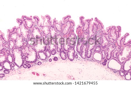 Microscopic image (photomicrograph) of a sessile serrated adenoma of colon.  Similar to tubular and villous adenomas, these precancerous polyps are removed by colonoscopy to prevent cancer.  Royalty-Free Stock Photo #1421679455