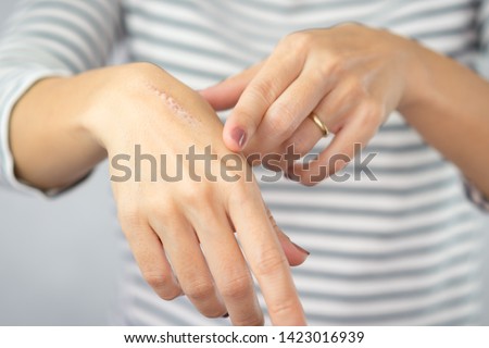Close up: First degree heat burn scar on a woman's hand. The wound damage on epidermis outermost layer of skin. Healing, Removal, Treatment, Accident in the kitchen, Scar, Scald, Wound Healing, Repair Royalty-Free Stock Photo #1423016939