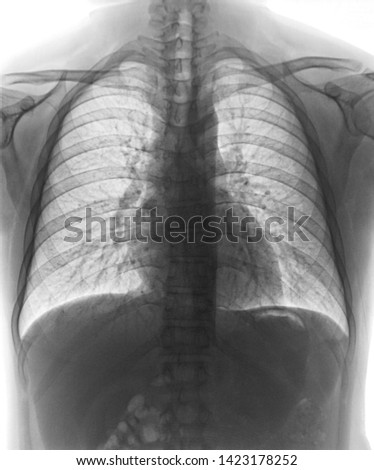 Film chest x-ray PA ,  Human Chest.                              