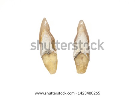 Limestone sticks deep into the tooth nerve root.