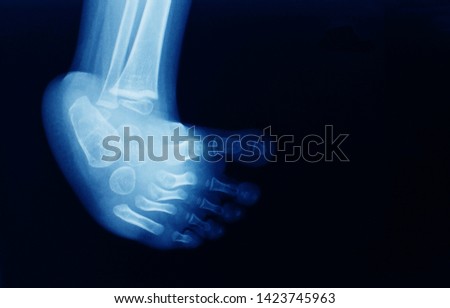 Foot x-ray of a child with birth defect and deformity. Clubfoot or talipes equinovarus present with cavus foot, varus foot, metatarsus adductus and equinovarus. Ponseti casting is needed. Royalty-Free Stock Photo #1423745963