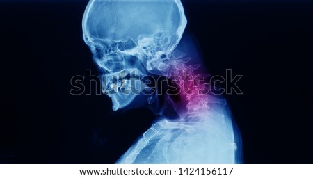 Lateral cervical spine x-ray showing spondylosis with kyphotic deformity of cervical spine. Chin to chest deformity. It cause neck pain, spondylotic myelopathy and radiculopathy.  Royalty-Free Stock Photo #1424156117