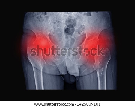 film x-ray hip radiograph show femoral head collapse form bone infarction or avascular necrosis (AVN) or Osteonecrosis (ON) disease. Red highlight on painful area. Medical imaging concept. Royalty-Free Stock Photo #1425009101