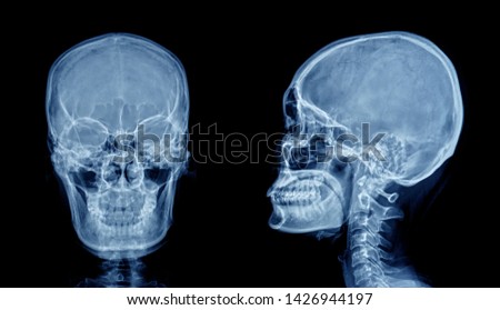 Film x-ray skull ,human's skull                               