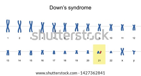 Down's syndrome karyotype, Autosomal abnormalities, Trisomy 21, vector illustration eps10 Royalty-Free Stock Photo #1427362841