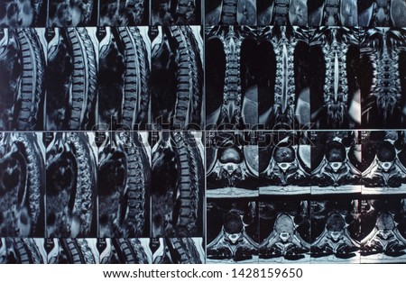 Magnetic resonance imaging of the human spine. Hernia on the spine.