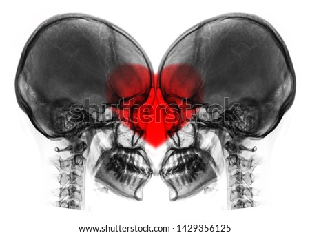 x-ray image of skull making heart symbols.