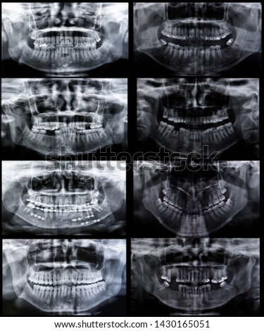 Panoramic dental collages ,human x-ray