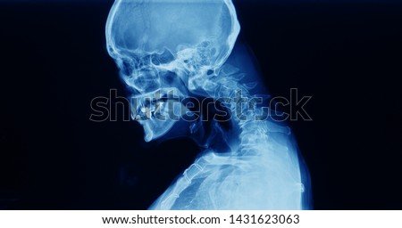Cervical spine x-ray showing spondylosis with kyphotic deformity of cervical spine. Chin to chest deformity. It cause neck pain, spondylotic myelopathy and radiculopathy. Dropped head syndrome. Royalty-Free Stock Photo #1431623063