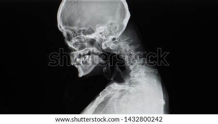 Cervical spine x-ray showing spondylosis with kyphotic deformity of cervical spine. Chin to chest deformity. It cause neck pain, spondylotic myelopathy and radiculopathy. Dropped head syndrome. Royalty-Free Stock Photo #1432800242