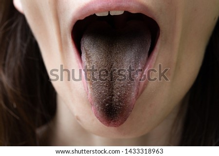 A closeup view of a girl with black hairy tongue (enterobacter cloacae). A common symptom of a bacterial infection in the mouth.