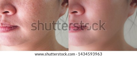 Image before and after spot melasma pigmentation skin facial treatment on face asian woman. Problem skincare and health concept.  Royalty-Free Stock Photo #1434593963