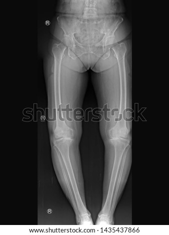 film x-ray knee radiograph showing bow leg deformity (genu varus or bowlegged) from knee arthritis disease (osteoarthritis or OA disorder) which cause knee pain and walking problem.(R = right side) Royalty-Free Stock Photo #1435437866