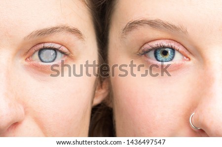 Woman showing eyes before and after cataract removal and corneal cleansing Royalty-Free Stock Photo #1436497547