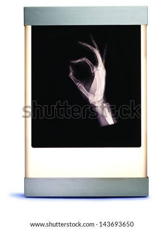 X Ray of Hand on Lightbox