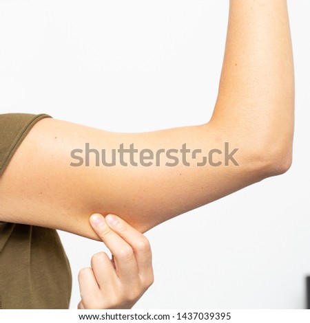 Female arm with excess skin due to rapid weight loss. Detail of the hand that pulls the adipose panniculus Royalty-Free Stock Photo #1437039395