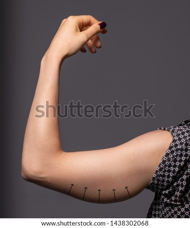 A young woman’s arm is seen up close before a brachioplasty procedure. Arrows point up to show the direction the lady wishes the loose skin to go after successful surgery. Royalty-Free Stock Photo #1438302068
