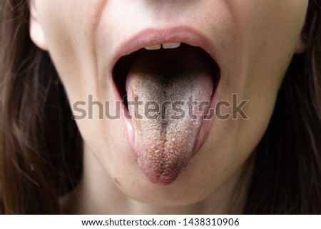 A close up view on the mouth of a thirty something girl, opening her mouth to reveal symptoms of a bacterial infection. Black hairy tongue.