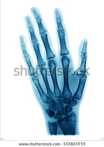 X-ray picture of hand