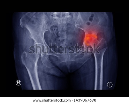 film X-ray hip radiograph show femoral head collapse form Avascular necrosis (AVN) or Osteonecrosis (ON) disease and arthritis joint. Highlight on painful area. Medical imaging concept. Royalty-Free Stock Photo #1439067698