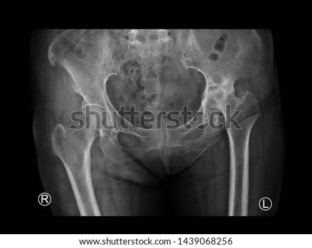 film X ray hip radiograph show femoral head collapse form bone infarction or avascular necrosis (AVN) or Osteonecrosis (ON) disease with progressive arthritis joint. Medical imaging concept. Royalty-Free Stock Photo #1439068256