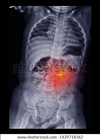 Film X ray radiograph of abdomen show metallic foreign body in the bowel.
The kid swallow a coin. Medical child safety and protection concept. Royalty-Free Stock Photo #1439718362