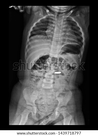 Film X-ray radiograph of abdomen show metallic foreign body in the bowel.
The kid swallow a coin. Medical child safety and protection concept. Royalty-Free Stock Photo #1439718797