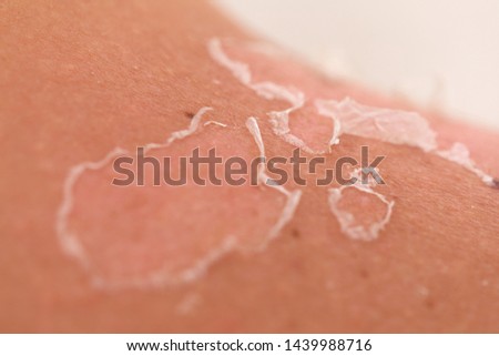 Close up picture of skin peeling after sunburn at on summertime