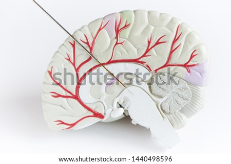 Concept of brain wave recording in Parkinson disease surgery. Microelectrode recording in midbrain. Brain model on white background. Royalty-Free Stock Photo #1440498596