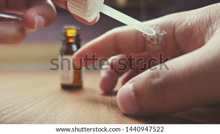 wart on finger after treatment by salicylic acid. wart on the finger verruca freeze,  healthcare and medical concept, blurred neutral light background from the window, selective focus Royalty-Free Stock Photo #1440947522