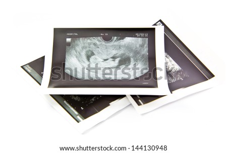 12 weeks infant baby ultrasound Image Royalty-Free Stock Photo #144130948