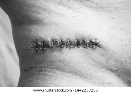 Department of Oncology Surgery. A picture of a postoperative medical suture after removal of a malignant tumor - moles. Malignant melanoma. Black and white photo, high contast