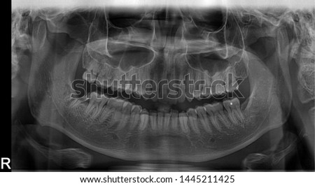 Panoramic radiograph showing Lingual nerve damage due to wisdom tooth extraction/surgery. Results in permanent damages including constant numbness, sharp pains and lost of taste function on tongue