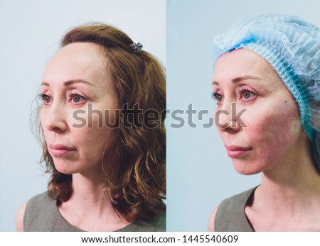 Aged woman doing mesothreads and Thread Lifting, Cosmetology. Cosmetic procedure to eliminate signs of aging. Beauty Face, Facial contour, plastic surgery concept for Age 40-50 years.