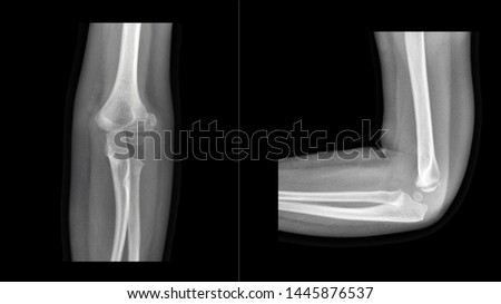 Film X ray elbow radiograph show elbow bone broken (lateral condyle of distal humerus fracture ) from sport injury. This is the most common fracture in children. Medical imaging concept Royalty-Free Stock Photo #1445876537