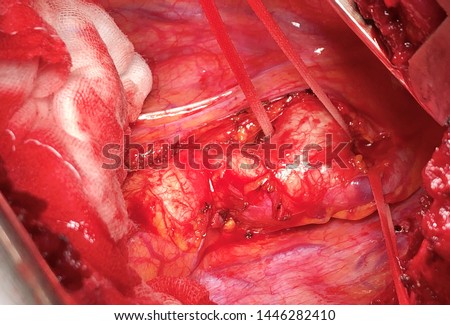 Coarctation of the aorta in adult (CoA or CoAo), also called aortic narrowing, is a congenital heart disease Royalty-Free Stock Photo #1446282410