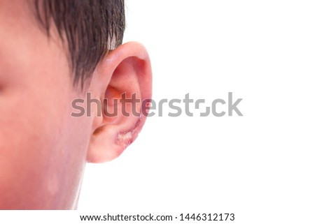 An ear skin infection of a boy,Ear wounds,Dermatitis caused by fungus.Incorrect treatment will cause more inflammation until pus.Isolated on white background.picture for hospital.child's health.
